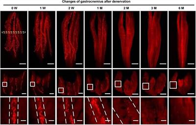 Denervation-Related Neuromuscular Junction Changes: From Degeneration to Regeneration